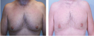 2-Male-breast-reduction-atlanta-alpharetta-georgia-ga